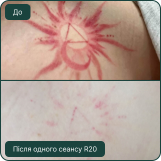 Видалення тату на нозі, фото до та після