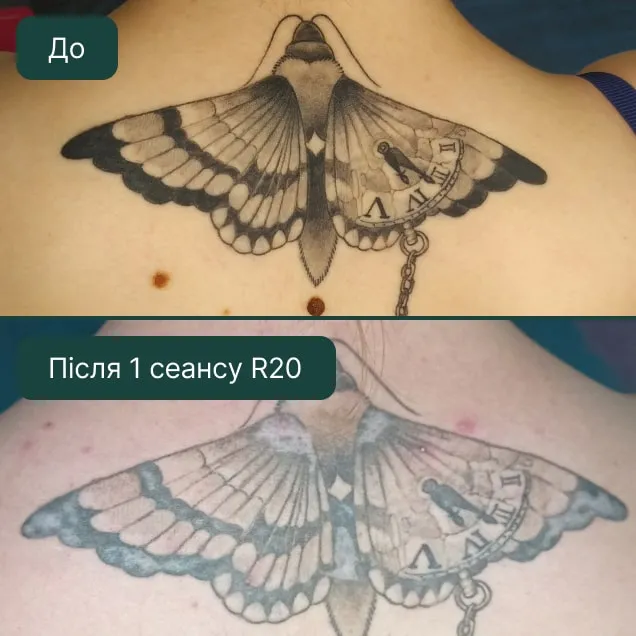 Видалення тату, фото до та після