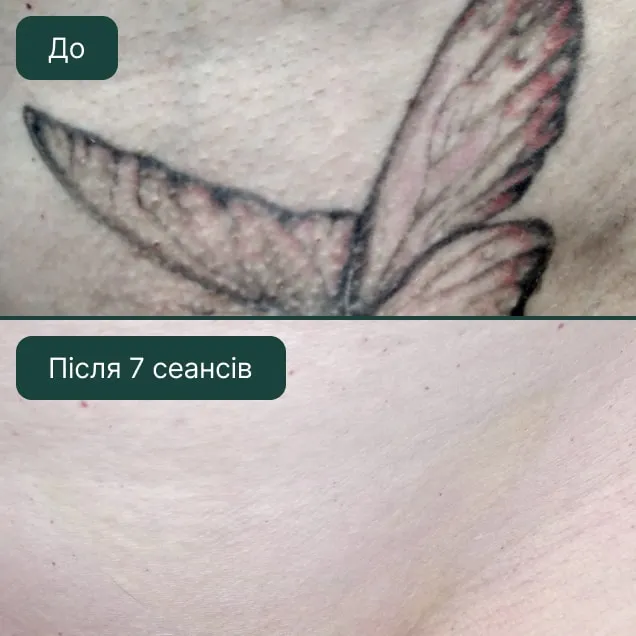 Видалення тату, фото до та після