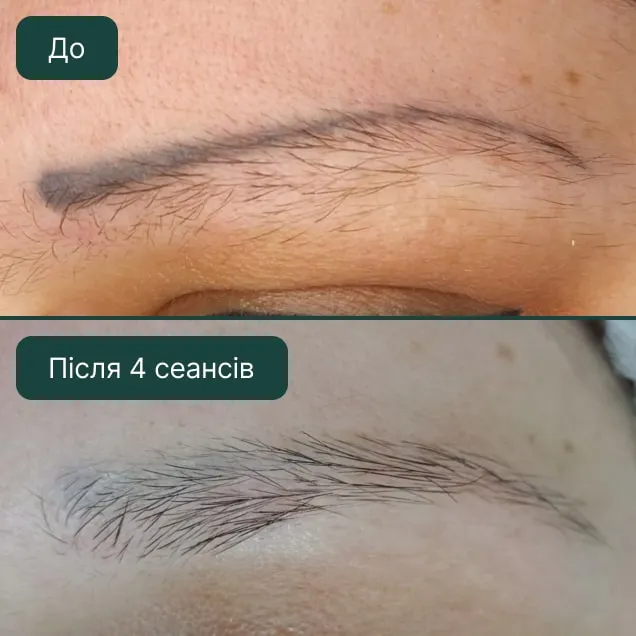 Видалення татуажу брів, фото до та після