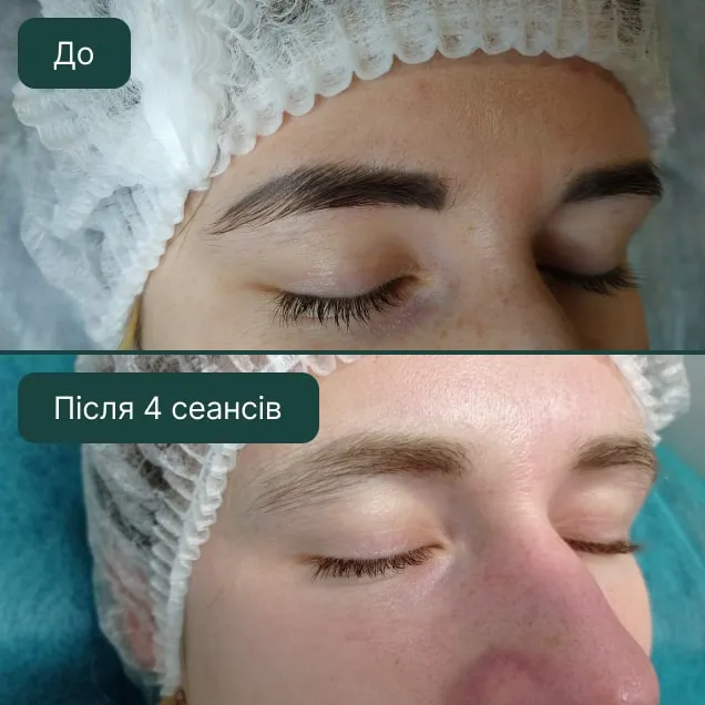 Видалення татуажу брів, фото до та після